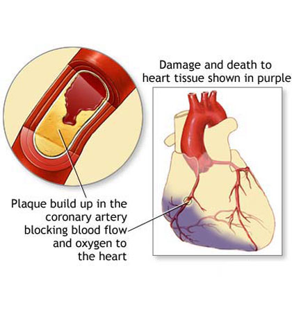 Phòng chống nhồi máu cơ tim