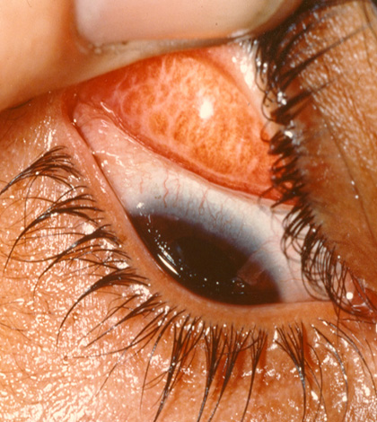 bệnh đau mắt hột