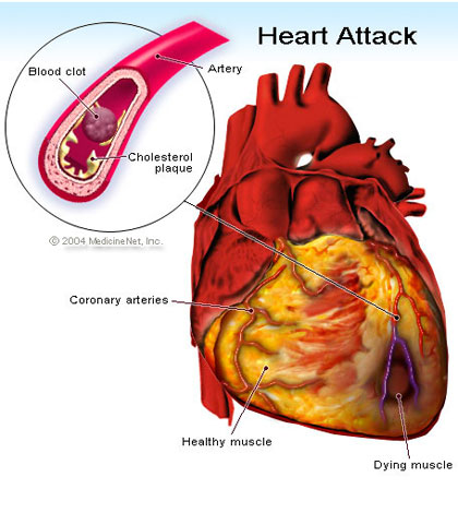 So sánh nhồi máu cơ tim và suy tim